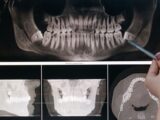 Detailed dental X-ray showing teeth structure highlighted by a pointing pen.
